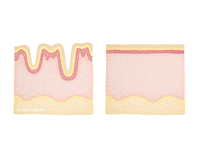 w_skincare_collagenfiller_dk_skin_before_after_miefrey_700x520